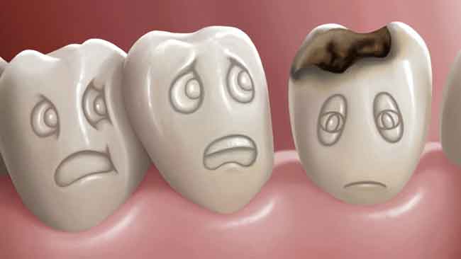 تسوس الأسنان  تعرف الأسباب وأهم النصائح والعلاجات له