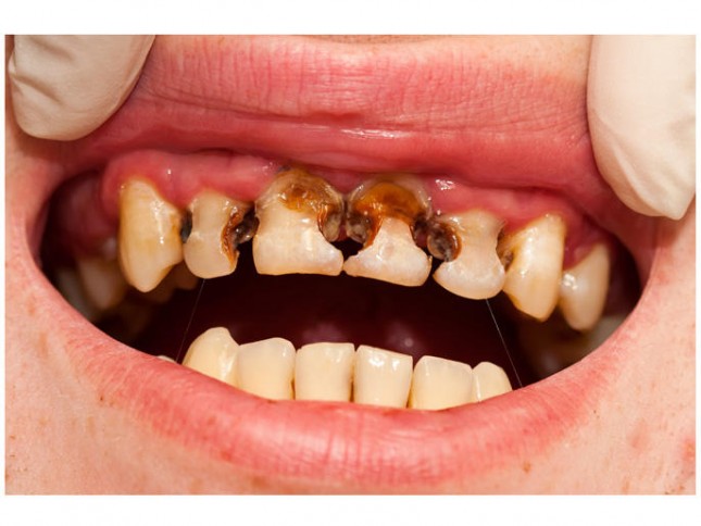 أسباب تسوس الأسنان وطرق علاجه